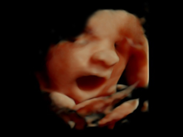 3D Ultraschall 12. SSW